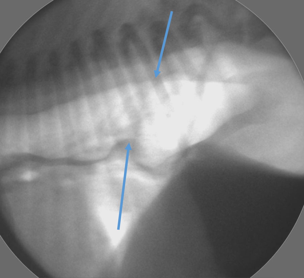 hiatal-hernia-diagram